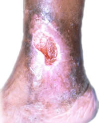 Ulcerul venos sau boala varicoasa