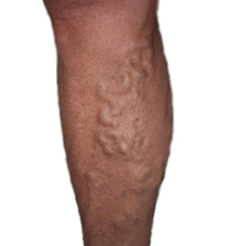 ciorapi de compresie de tratament cu varicoză picioarele umflate cu fotografii varicoase